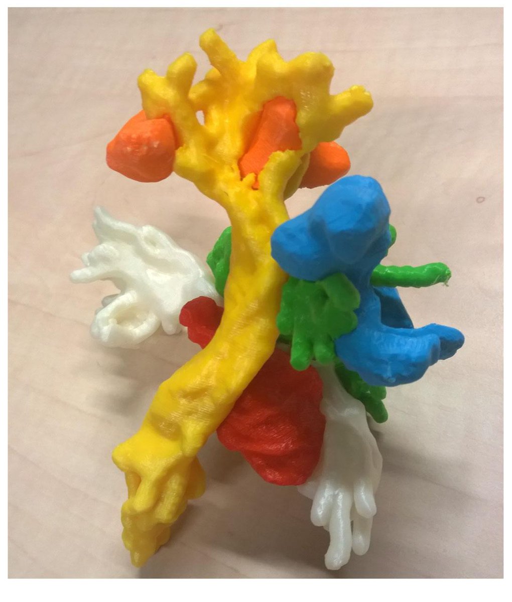 3D Lab Radboudumc (@3dlabradboudumc) on Twitter photo #3Dprint braintumor for neurosurgeon to give insight in best possible treatment #patientcare #healthcare <a href="/radboudumc/">Radboudumc</a> #3Dprint braintumor for neurosurgeon to give insight in best possible treatment #patientcare #healthcare <a href="/radboudumc/">Radboudumc</a>