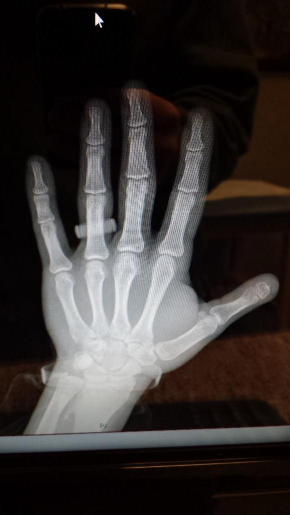 codycopp's tweet photo. An x-ray of my left hand rocking my #Qalo wedding band and my #IAmSecond wristband! God is great! http://t.co/ObfA41kPPd