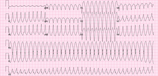 njmonline's tweet photo. Wide Complex #Tachycardia in Patient W Family History of Sudden Death http://t.co/yWllqhbICj #EKG http://t.co/dQ3SFpLszC"