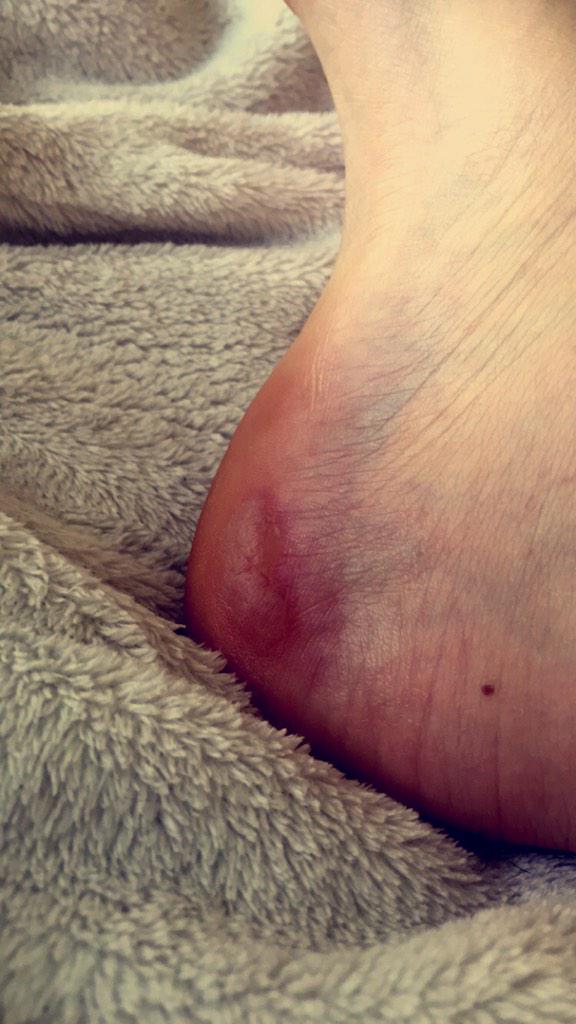 jessiiccamill's tweet image. From yesterday's hike, guess I need to break in my boots a little more? 😅 #hikingproblems