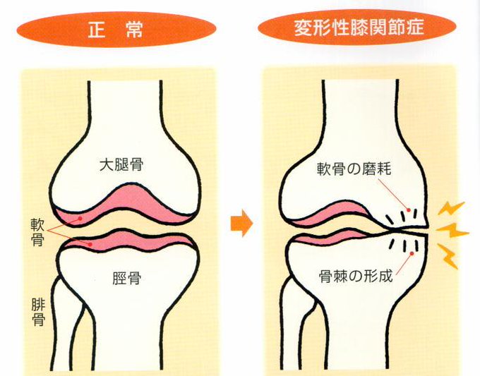 基礎医学のゴロ 知識大辞典さん のツイート 関節 の検索結果 1 Whotwi グラフィカルtwitter分析