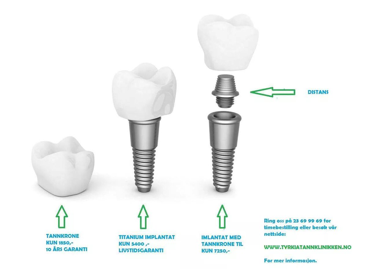 имплантация зубов поэтапно. акция имплантация зубов под ключ. дентальный имплант. акция на импланты. зубной имплант под ключ.