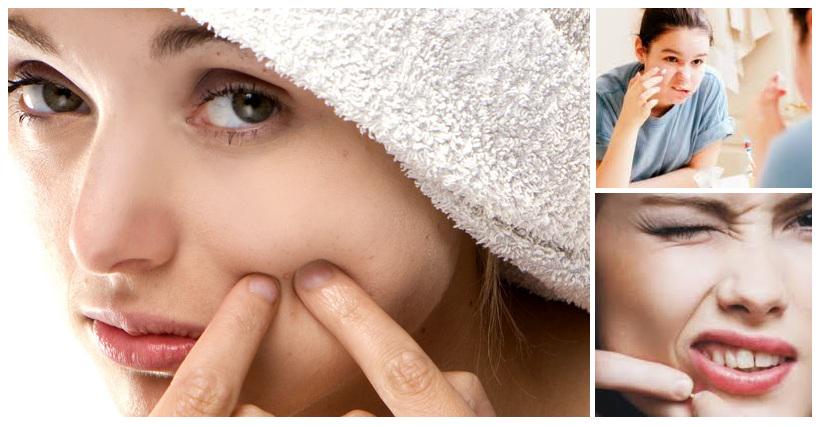 PeopleHOPEcom's tweet image. Bagaimana cara menghilangkan jerawat hingga tuntas?? simak pembahasan lengkapnya di peoplehope.com/chat/cara-meng…