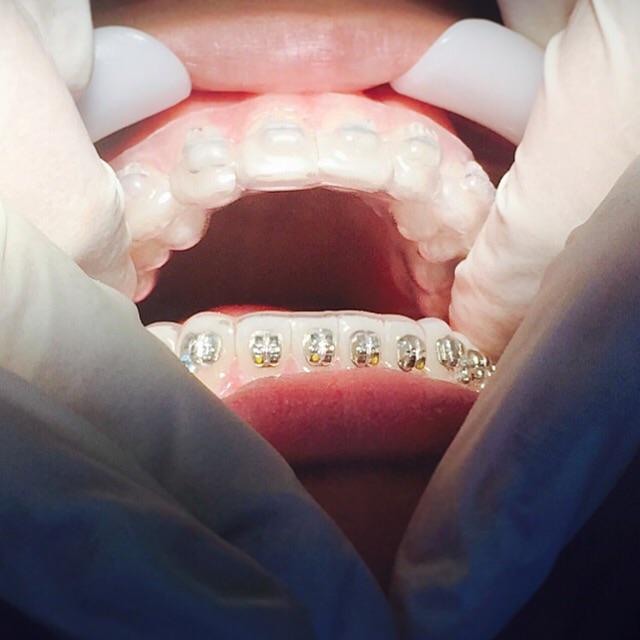 Braces being placed. Keep smiling 😄 #SPortho #braces #healthy #function #aesthetics #cosmetic #smile #straightteeth