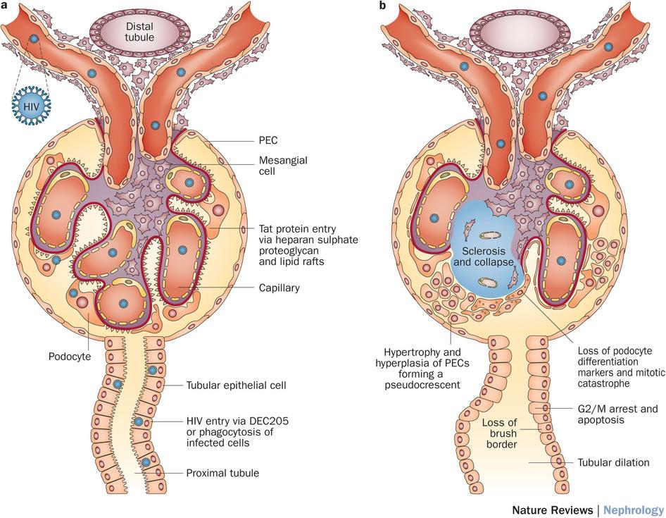 Jeffrey Kopp and colleagues provide an overview of HIV-associated nephropathies   rdcu.be/cb34