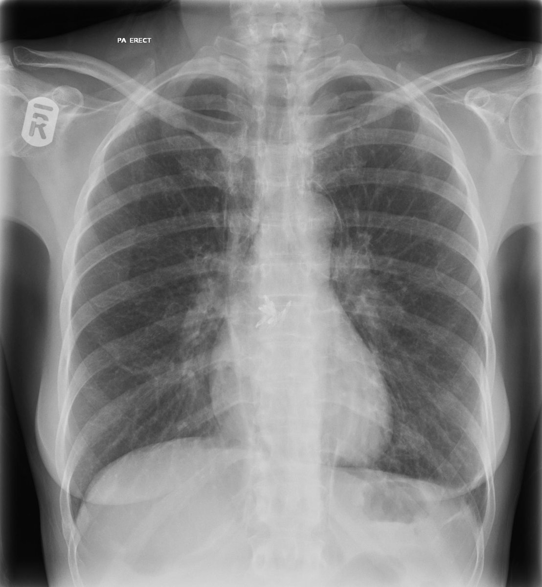 DrVikasShah's tweet image. What’s the story on this latest #xrayoftheweek? Typical exam case.

#FOAMRad #FOAMed #FRCR2b #rad2b #radiology