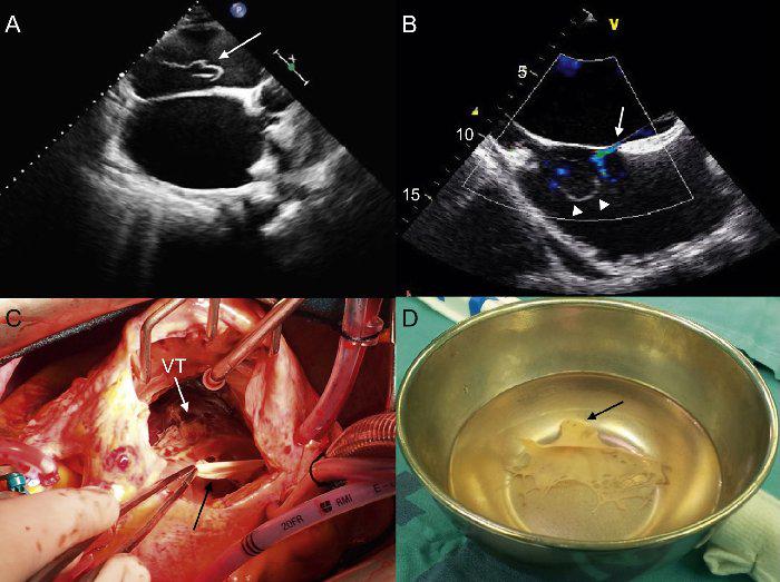 Ya está disponible en revespcardiol.org el número de Marzo 2015, Volumen 68, Número 03. #cardiologia