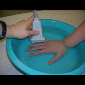 SonoSim's tweet photo. #USTip: A water bath can help image superficial structures that are proximal to the transducer's focal point  #FOAMus http://t.co/yvvRmv6WXW