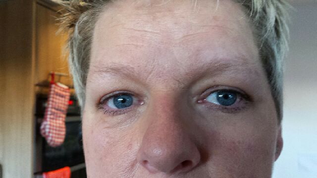 lipo_wave's tweet photo. Treated the under eye area with Instantly Ageless on one side, took this pic a few minutes later. Magic! http://t.co/po0oWQczJA