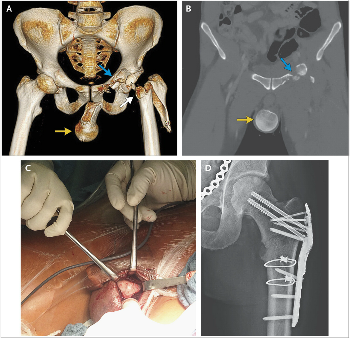 epmonthly's tweet photo. file this under "reasons to not ride motorcycles" http://t.co/EKbCE3HV0T from @NEJM HT @yzafar -ST http://t.co/yXf8hzsEYp