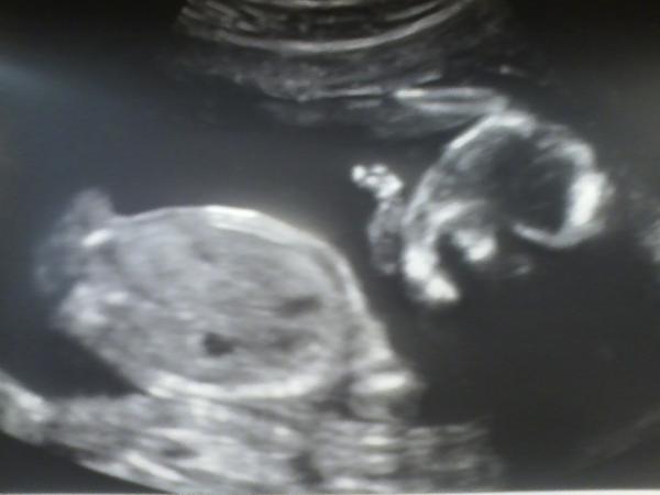 MissKathyMODEL's tweet photo. Baby #2 is a Girl <3 http://t.co/mbgWGMzcXx