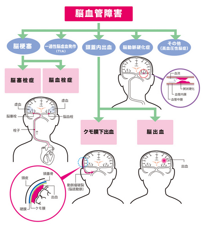 Twitter 上的 ゴロ 解剖生理イラスト 脳血管障害について Http T Co Zpq97jtujl Twitter