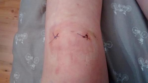 LanaKateRedgewe's tweet photo. Stitches came out today. Feeling loads better already! Will be back to winter training soon #Recovery #NeverGiveUp http://t.co/ZpOoocHTBV