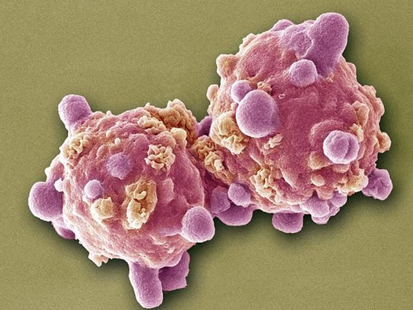 sttrcancer's tweet photo. What can you do to reduce #cancer risk? Follow this 12-point guide http://t.co/2Bafs7VCDS #CancerAwareness #here2cure http://t.co/AcZ7jcsr1b