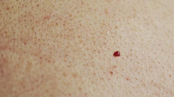 CuidateTu2's tweet photo. Descubre que significa tener lunares rojos
http://t.co/RisXwfTe6W http://t.co/zsspF5pQxi
