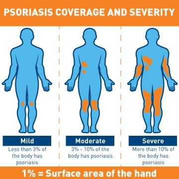 how to measure severity of psoriasis)