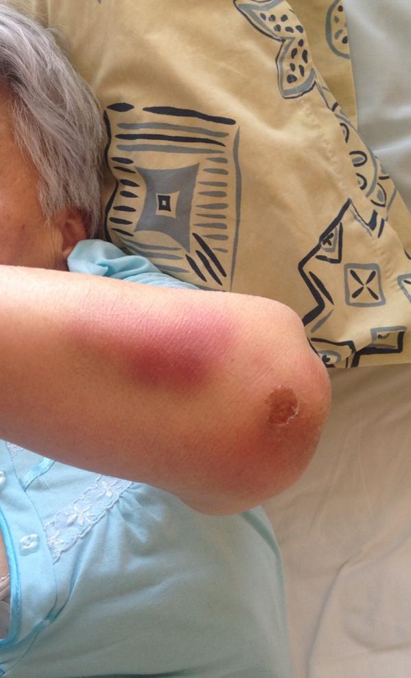 CcFrancisca's tweet photo. Dos noches en #HospitalFricke y mi tía abuela de 89 años vuelve en este estado. Cómo podríamos saber qué sucedió? http://t.co/G6w9mlRC32