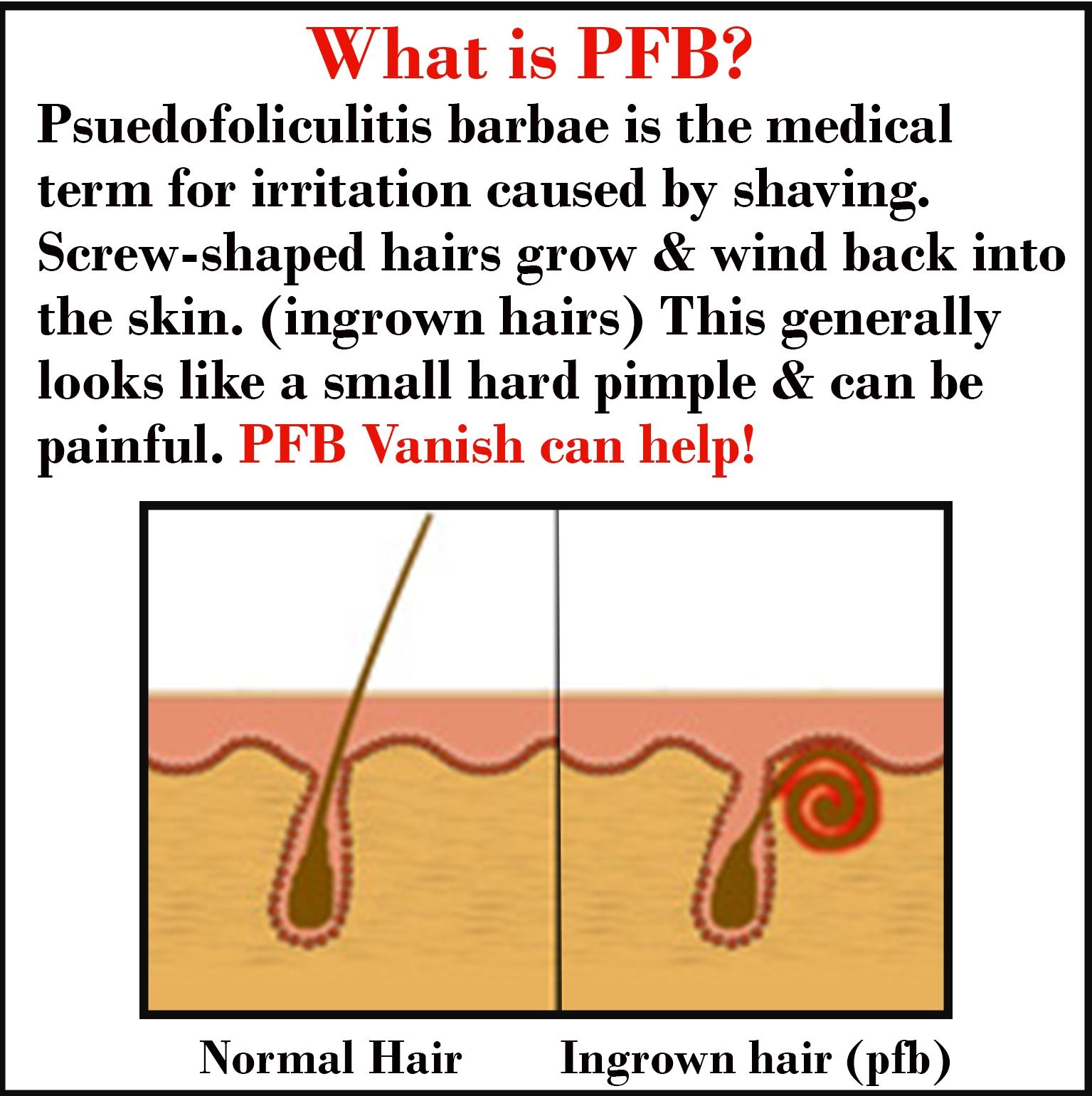 Pfb Vanish Usa On Twitter What S Pfb Psuedo Folliculitis