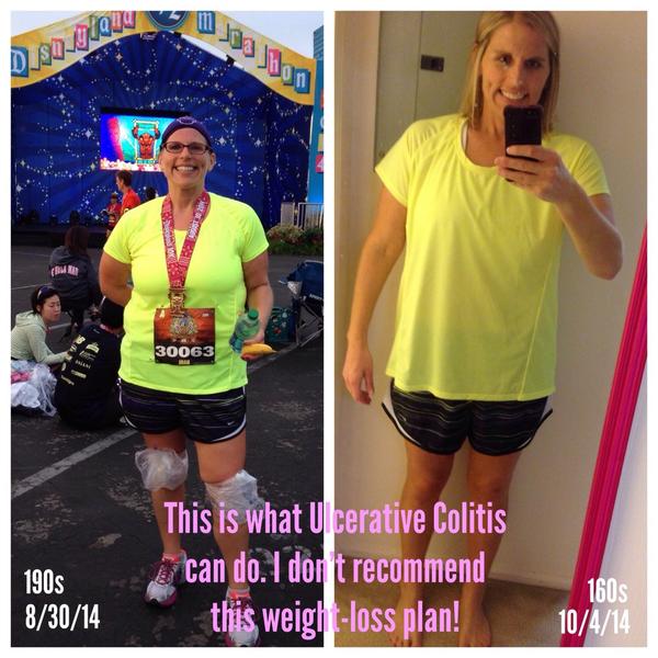 joangrott's tweet photo. @ccfa what can happen while waiting on a diagnosis. #IBDselfie #ulcerativecolitis #ibd #ccfa #grottstrong #weightloss http://t.co/4HVRfxTW89