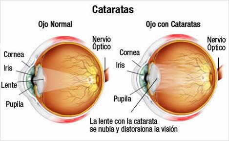 macularetina's tweet photo. Hablamos de CATARATAS con la Dra. García Roldán. El 31/10 en Jornadas Puertas Abiertas.Sevilla http://t.co/Rk2CudEl1F http://t.co/z7Y7afKOpQ