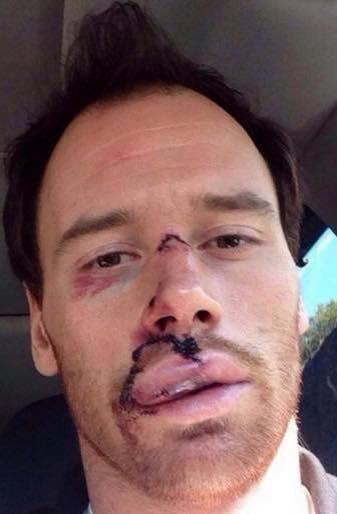 saucehockey's tweet photo. Martin Havlat.  44 stitches, lip sewn back on to his face, broken nose andddddddd playing tomorrow night #saucelife http://t.co/FH8GtWo6uu