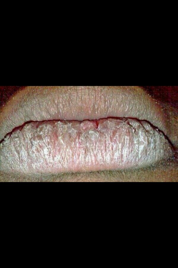 brokeproblems_'s tweet image. When it&apos;s winter time and you lose you Chapstick...