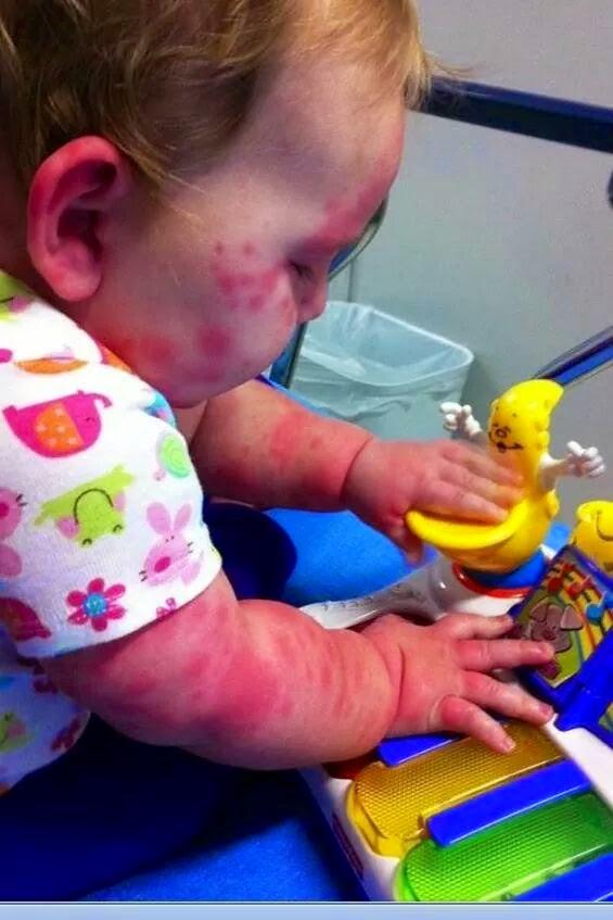 #MastCellMomma - Tara's Story"We were turned away by FIVE doctors..."
mastcellmomma.blogspot.com/2014/10/i-dont…
#MastCellAwareness