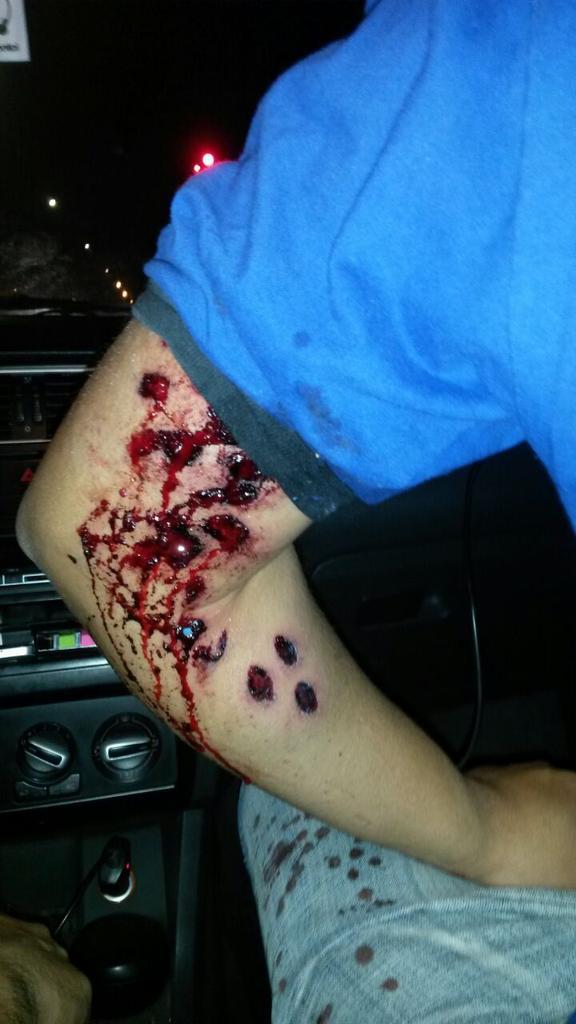 myriambregman's tweet photo. Las heridas de un trabajador de Donnelley, terrible http://t.co/vrqhoI3kg1