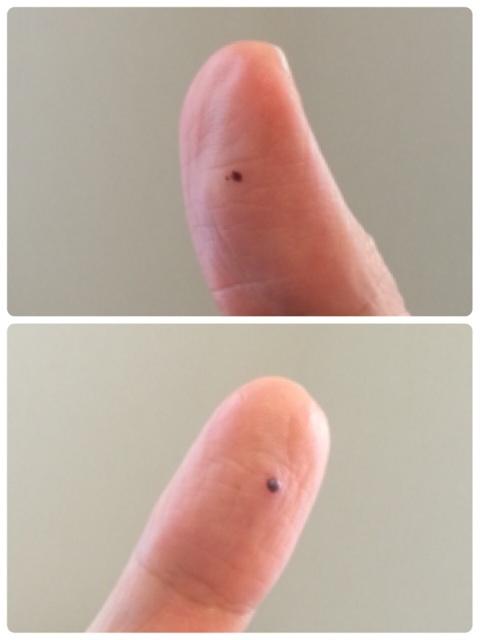 Hiroru 左右の親指に 突如ほくろか血豆のようなものが出現 どこかに強く挟んだ記憶もない 怖い 皮膚ガンとかじゃないよね Http T Co Wgm1suds0t