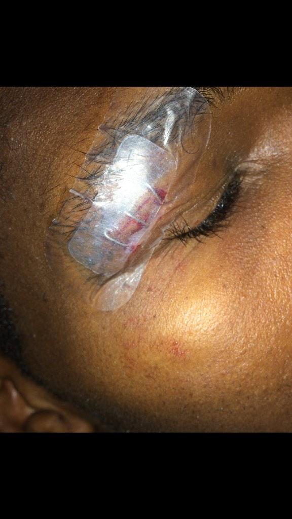 TMbakwe32's tweet photo. The things I put my body through to play basketball 😩😭 #3staples http://t.co/rIsAnFYqAb