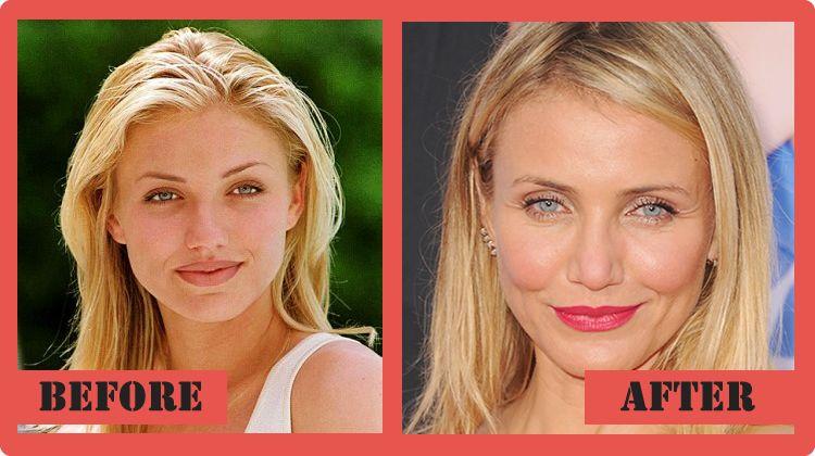 Cameron Diaz Plastic Surgery Before And After