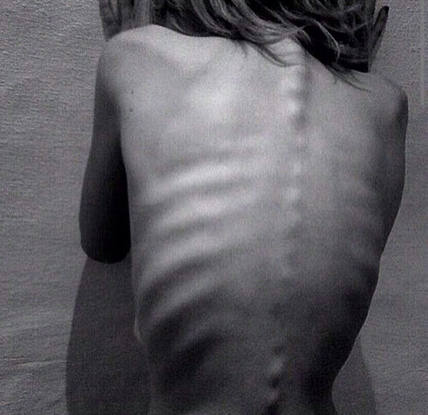 Kiss_0f_Death_'s tweet image. #thinspo #ribs #ribbones #spine