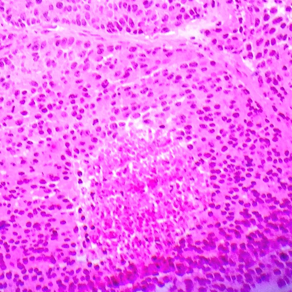 divyasharmamd's tweet photo. Extra axial brain mass in 66yM with h/o prostate cancer. @PathologyGlory @Pathquiz @JMGardnerMD @NivesZimm http://t.co/QZOeQOufV0