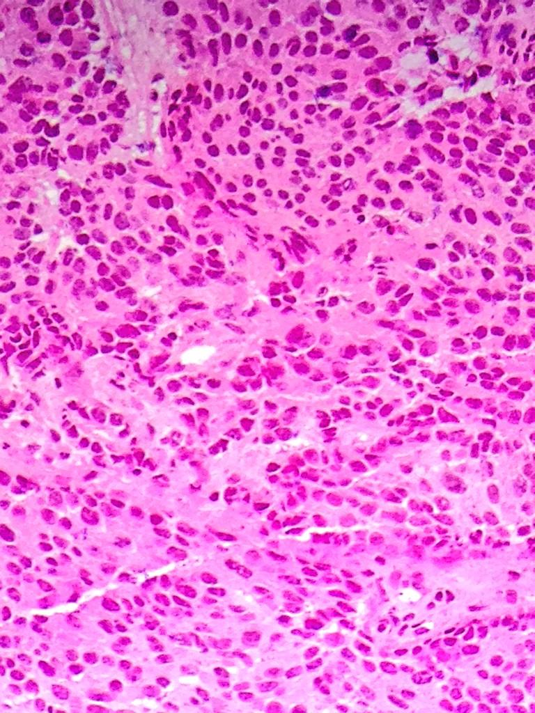 divyasharmamd's tweet photo. Extra axial brain mass in 66yM with h/o prostate cancer. @PathologyGlory @Pathquiz @JMGardnerMD @NivesZimm http://t.co/QZOeQOufV0