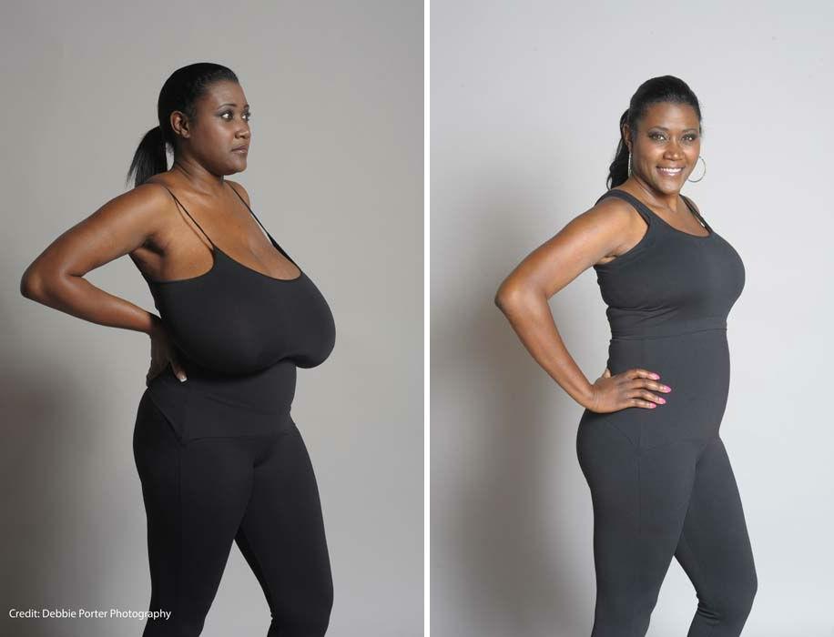 ABC 7 Chicago on X: Tex. woman gets life-changing surgery to reduce 36NNN  breasts. PHOTOS:   / X