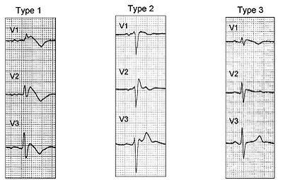 EMBoardReview's tweet photo. Mattu discussing Brugada at #ACEP14.  Need to know images and topic for #emboardreview. Coved pattern most sens/spec http://t.co/QirFjZKkhG