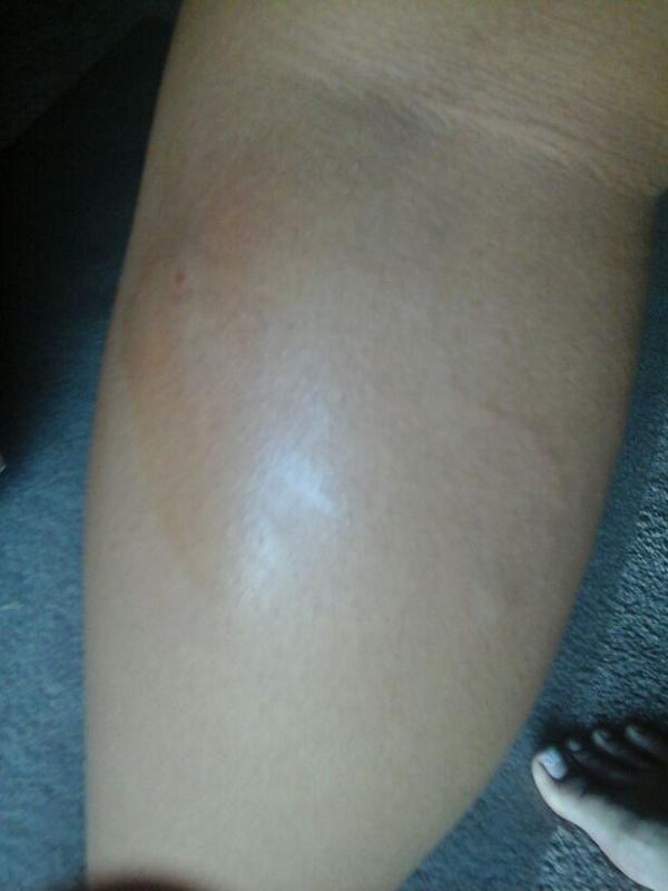 I Juat got attacked by a dog while walking home from 7-11. Stupidddd doggg left a mark. It hurts badly