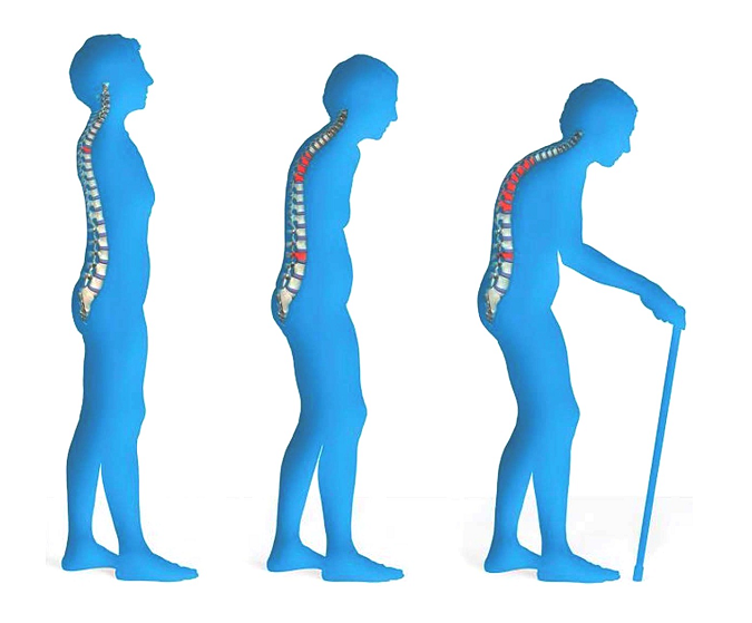 ammommx's tweet photo. "@MedkoES: La #osteoporosis es una afección que debilita los huesos #Medko:http://t.co/99pe4Ghpzu http://t.co/oDdKinxZDg"