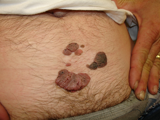 MedkoES's tweet photo. Las Verrugas Genitales están causadas por el virus del papiloma humano. Más información: http://t.co/PbSiNVZPz5 http://t.co/DCkf7KurQi