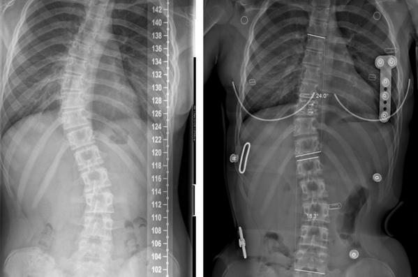 GretaBrink's tweet photo. With #cheneau #scoliosis #scoliose #brace and #Schroth #therapy, from 39 to 24 degr (in brace #EOS) after 2 months. http://t.co/o7k5E8n36j