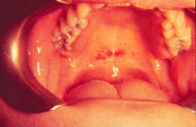 MedkoES's tweet photo. La #Mononucleosis es una enfermedad vírica infecciosa. Más información de Medko: http://t.co/7u9B3uW9nS http://t.co/Gzb06WJQQu