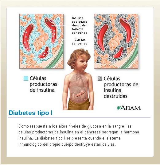 #Diabetes tipo 1