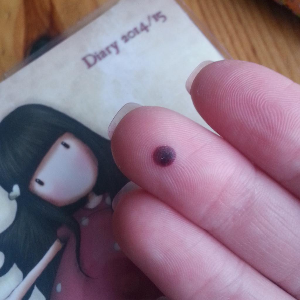 mindofgeekness's tweet photo. How's that for a blister? :( #stoopidwork http://t.co/3E2LFR6GT3