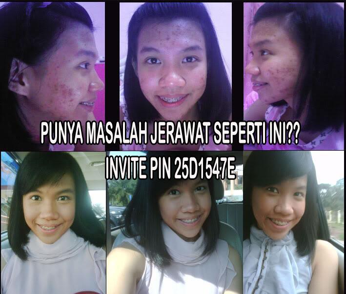 memiliki masalah kulit wajah jerawat radang seperti ini ? invite 25D1547E utk konsultasi :)