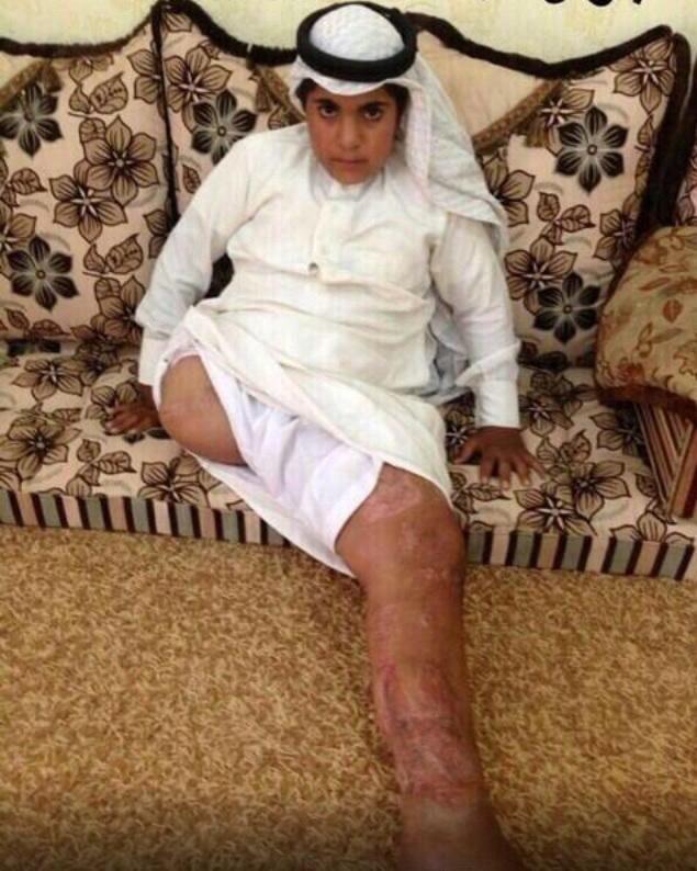 اصابة بالايدز ملوث حائل