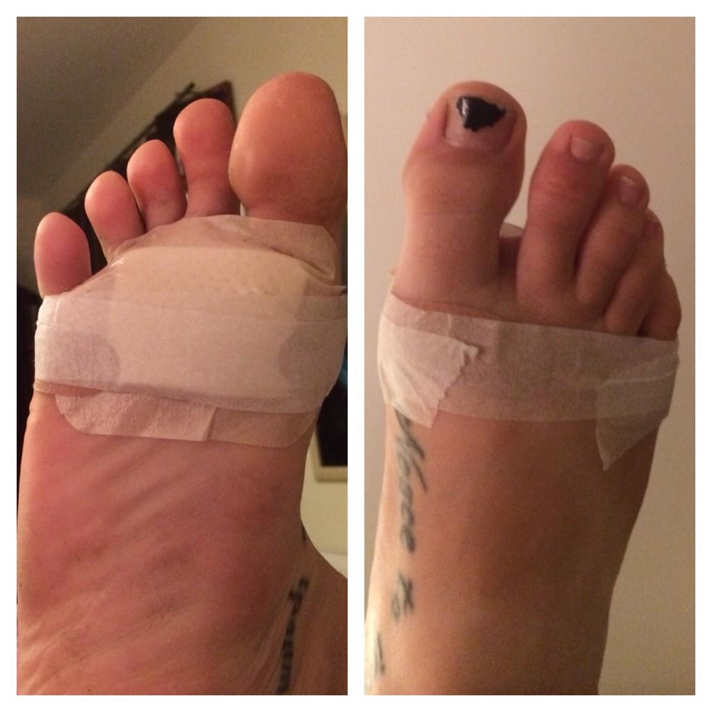 Madame_Amber's tweet image. Thanks, @wolfy_adder   No. Really. Thanks #muchpain #ow #infected #blisters #throbbing #pus #ihaychu #lasagnefactory