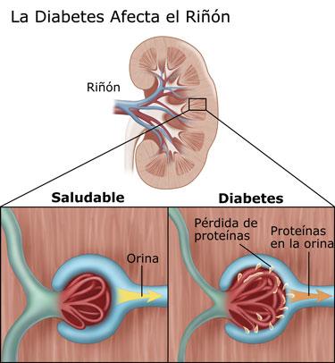 La #diabetes puede afectar tus riñones.