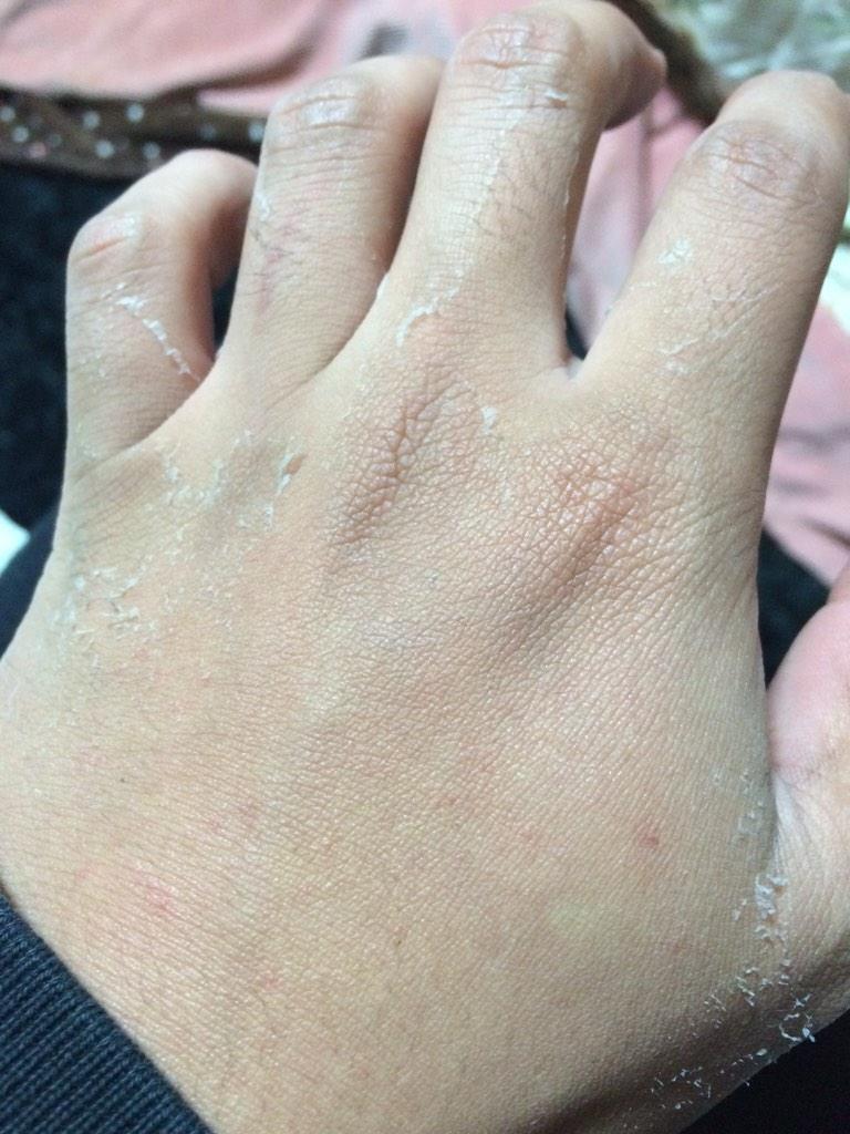 近藤しんや 手の皮ボロボロ そろそろ脱皮の時期やもんな Http T Co Zhuq7peac7 近藤しんや 手の皮ボロボロ そろそろ脱皮の時期やもんな Http T Co Zhuq7peac7