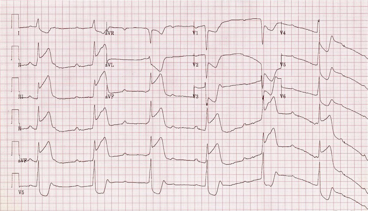 EilidhPinkChic's tweet image. In context of STEMI + CHB: inferior STEMI better than anterior 
“@ECGclass: complete heart block ECG.  #ECGclass http://t.co/Owa3jqhhyw”