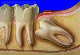 classipel's tweet image. Dente siso - Extração - classipel.com/dente-siso-ext…